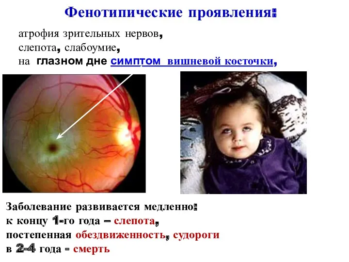 атрофия зрительных нервов, слепота, слабоумие, на глазном дне симптом вишневой