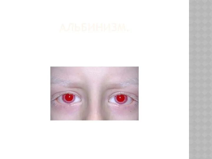 АЛЬБИНИЗМ.