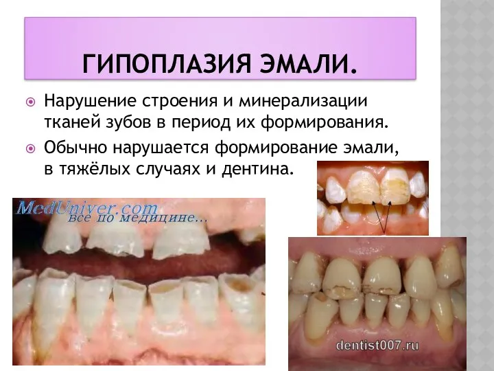 ГИПОПЛАЗИЯ ЭМАЛИ. Нарушение строения и минерализации тканей зубов в период
