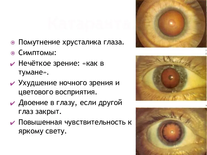 Катаракта. Помутнение хрусталика глаза. Симптомы: Нечёткое зрение: «как в тумане».