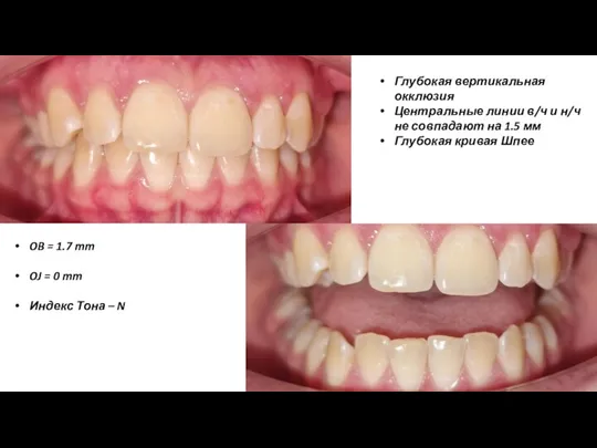 Глубокая вертикальная окклюзия Центральные линии в/ч и н/ч не совпадают