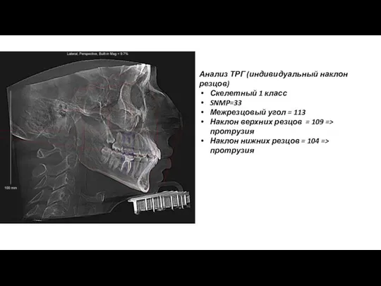 Анализ ТРГ (индивидуальный наклон резцов) Скелетный 1 класс SNMP=33 Межрезцовый