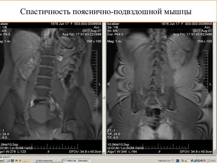 Спастичность пояснично-подвздошной мышцы