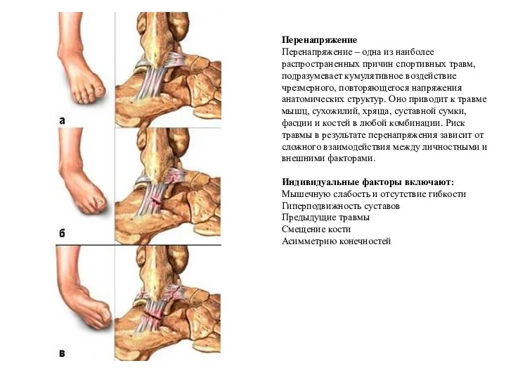 Перенапряжение Перенапряжение – одна из наиболее распространенных причин спортивных травм,