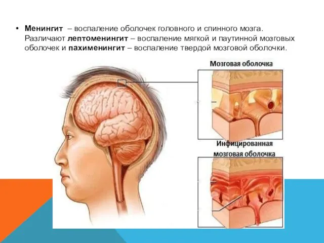 Менингит – воспаление оболочек головного и спинного мозга. Различают лептоменингит
