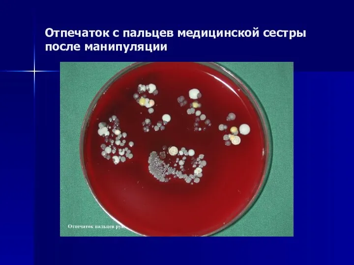 Отпечаток с пальцев медицинской сестры после манипуляции