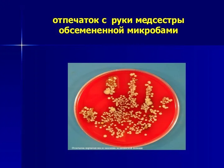 отпечаток с руки медсестры обсемененной микробами