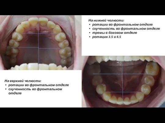 На нижней челюсти: ротации во фронтальном отделе скученность во фронтальном