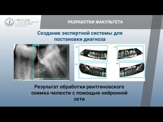 РАЗРАБОТКИ ФАКУЛЬТЕТА Создание экспертной системы для постановки диагноза Результат обработки рентгеновского снимка челюсти