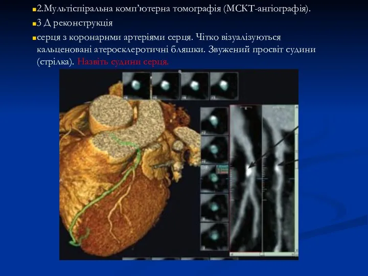 2.Мультіспіральна комп’ютерна томографія (МСКТ-ангіографія). 3 Д реконструкція серця з коронарнми
