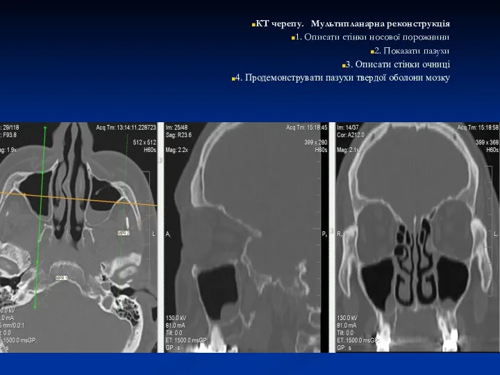 КТ черепу. Мультипланарна реконструкція 1. Описати стінки носової порожнини 2.