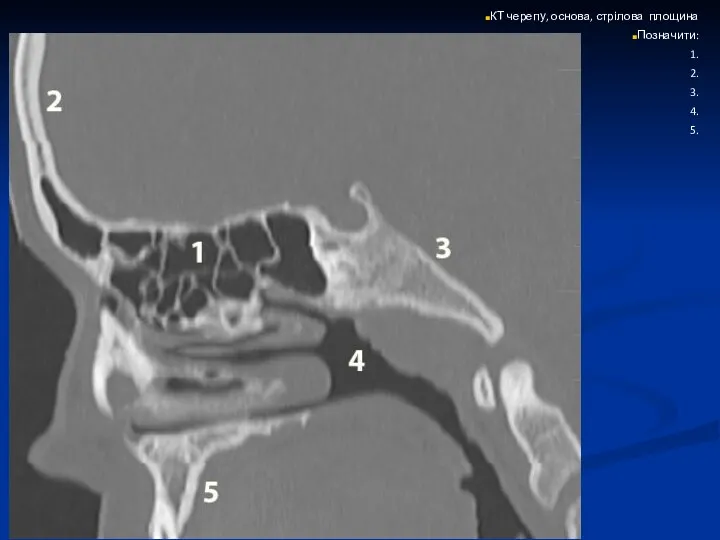 КТ черепу, основа, стрілова площина Позначити: 1. 2. 3. 4. 5.