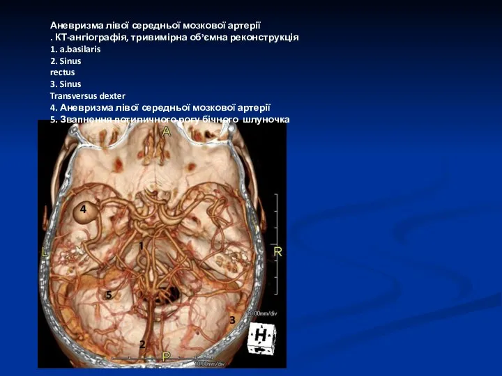 Аневризма лівої середньої мозкової артерії . КТ-ангіографія, тривимірна об’ємна реконструкція