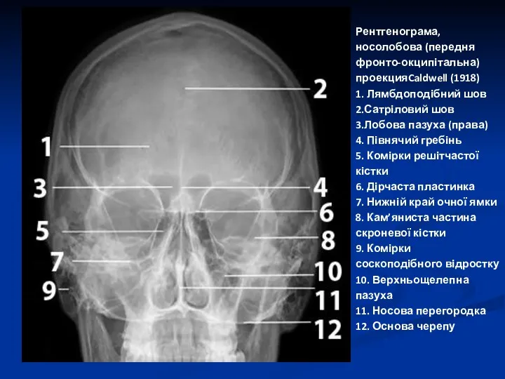 Рентгенограма, носолобова (передня фронто-окципітальна) проекцияCaldwell (1918) 1. Лямбдоподібний шов 2.Сатріловий