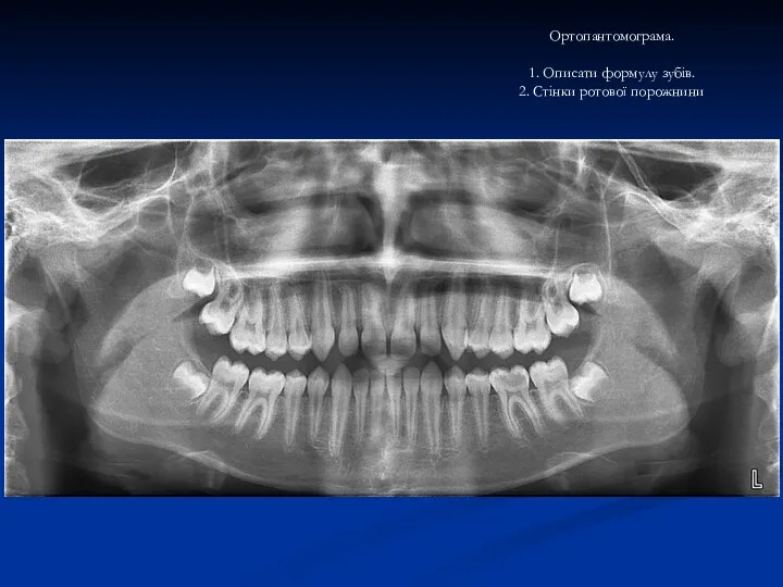 Ортопантомограма. 1. Описати формулу зубів. 2. Стінки ротової порожнини