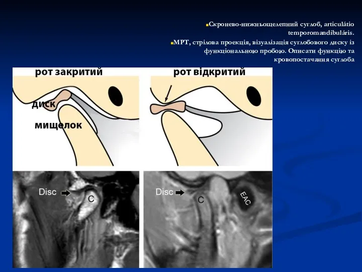 Скронево-нижньощелепний суглоб, articulátio temporomandibuláris. МРТ, стрілова проекція, візуалізація суглобового диску