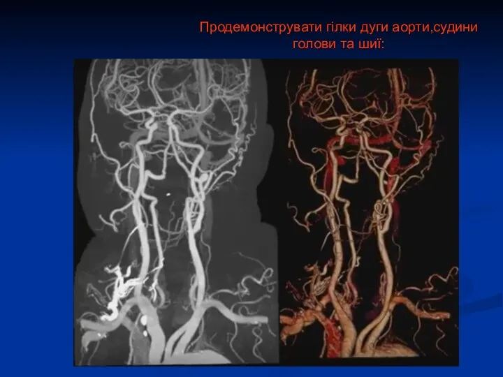 Продемонструвати гілки дуги аорти,судини голови та шиї: