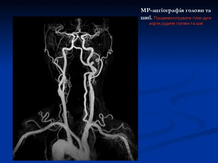 МР-ангіографія голови та шиї. Продемонструвати гілки дуги аорти,судини голови та шиї