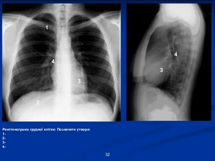 1 2 3 4 Рентгенограма грудної клітки: Позначити утвори: 1- 2- 3- 4- 3 4