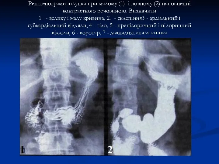 Рентгенограми шлунка при малому (1) і повному (2) наповненні контрастною