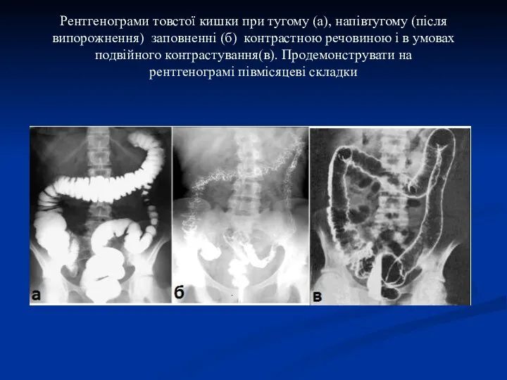Рентгенограми товстої кишки при тугому (а), напівтугому (після випорожнення) заповненні