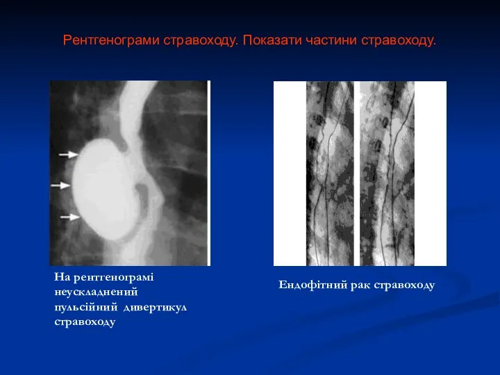 Рентгенограми стравоходу. Показати частини стравоходу. На рентгенограмі неускладнений пульсійний дивертикул стравоходу Ендофітний рак стравоходу