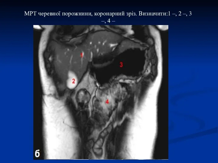 МРТ черевної порожнини, коронарний зріз. Визначити:1 –, 2 –, 3 –, 4 –