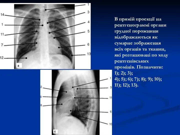 В прямій проекції на рентгенограммі органи грудної порожнини відображаються як