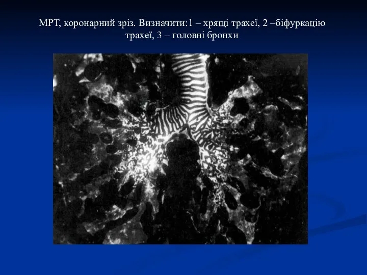 МРТ, коронарний зріз. Визначити:1 – хрящі трахеї, 2 –біфуркацію трахеї, 3 – головні бронхи