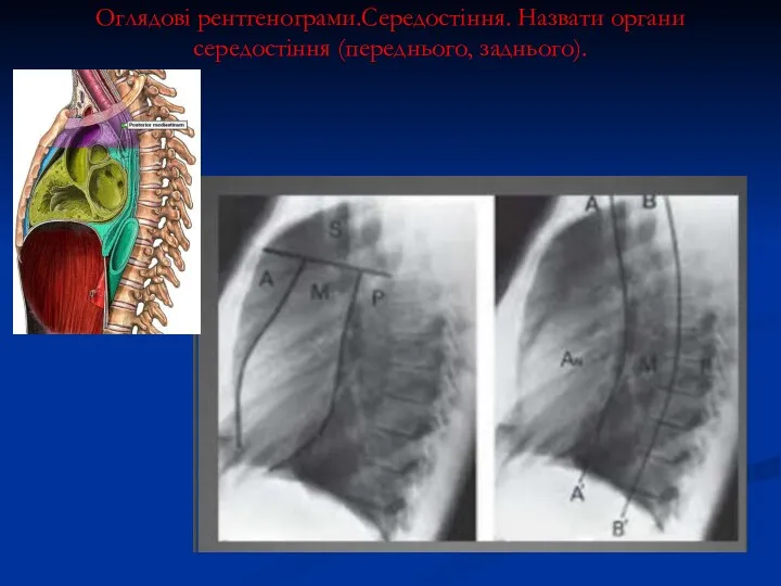 Оглядові рентгенограми.Середостіння. Назвати органи середостіння (переднього, заднього).