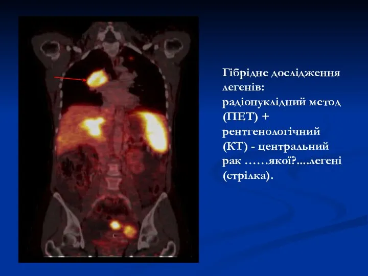 Гібрідне дослідження легенів: радіонуклідний метод (ПЕТ) + рентгенологічний (КT) - центральний рак ……якої?....легені (стрілка).