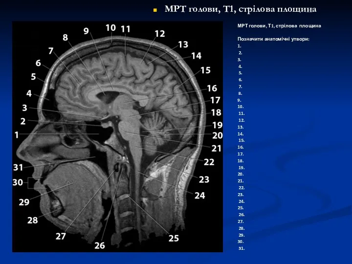 МРТ голови, Т1, стрілова площина МРТ голови, Т1, стрілова площина