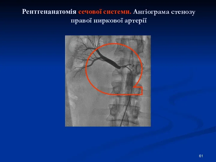 Рентгенанатомія сечової системи. Ангіограма стенозу правої ниркової артерії