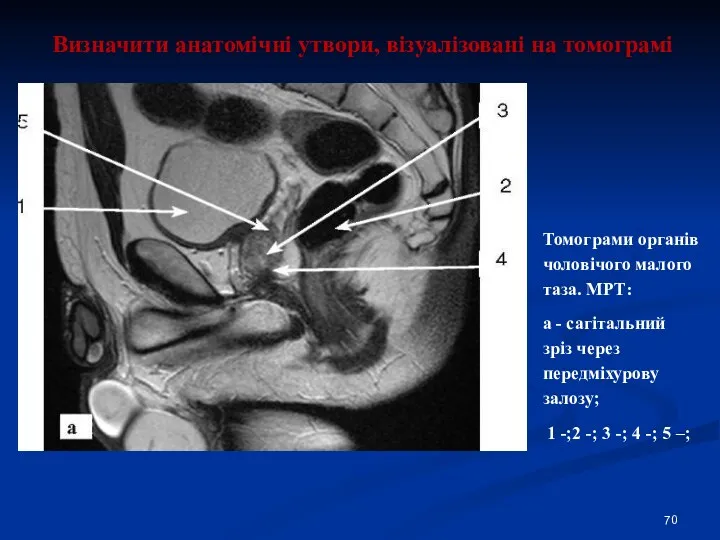 Визначити анатомічні утвори, візуалізовані на томограмі Томограми органів чоловічого малого