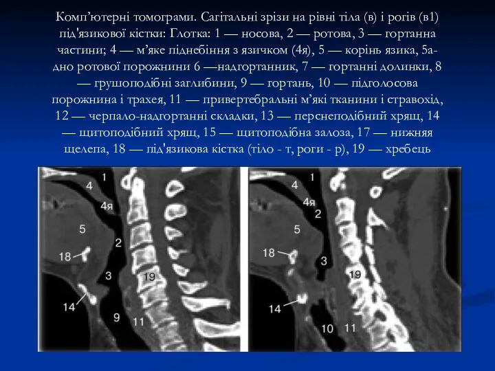 Комп’ютерні томограми. Сагітальні зрізи на рівні тіла (в) і рогів