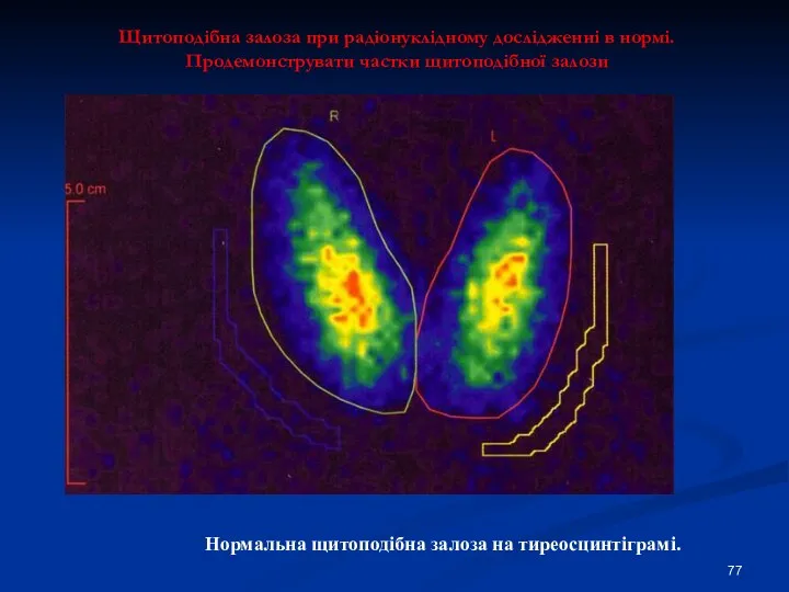 Щитоподібна залоза при радіонуклідному дослідженні в нормі. Продемонструвати частки щитоподібної залози Нормальна щитоподібна залоза на тиреосцинтіграмі.
