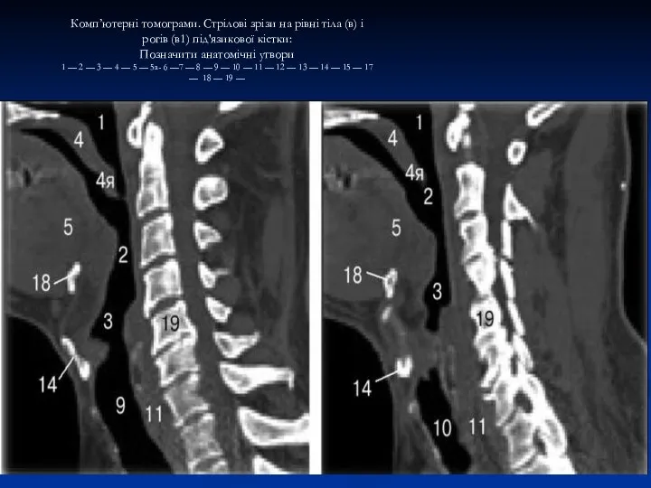 Комп’ютерні томограми. Стрілові зрізи на рівні тіла (в) і рогів