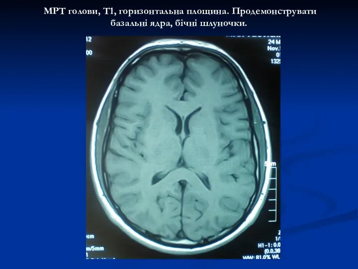 МРТ голови, Т1, горизонтальна площина. Продемонструвати базальні ядра, бічні шлуночки.