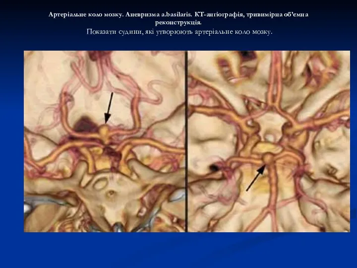 Артеріальне коло мозку. Аневризма a.basilaris. КТ-ангіографія, тривимірна об’ємна реконструкція. Показати судини, які утворюють артеріальне коло мозку.