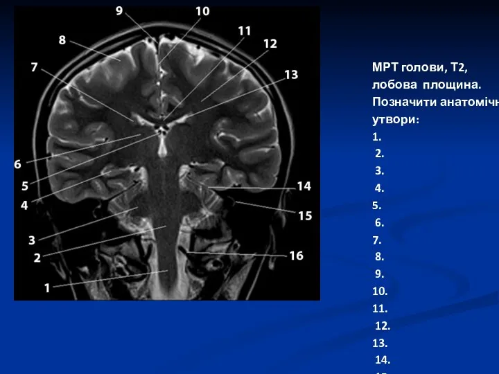 МРТ голови, Т2, лобова площина. Позначити анатомічні утвори: 1. 2.