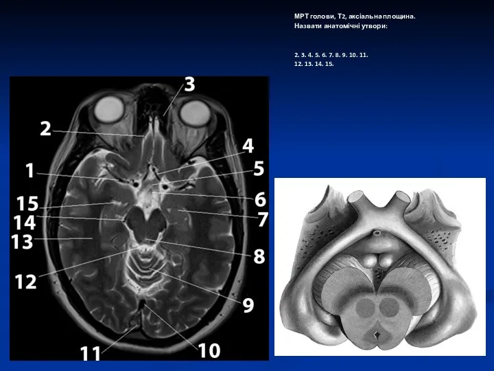 МРТ голови, Т2, аксіальна площина. Назвати анатомічні утвори: 2. 3.