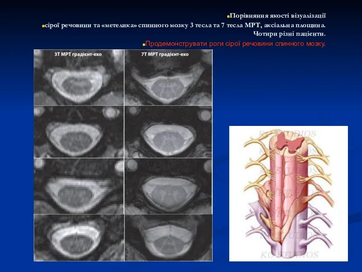 Порівняння якості візуалізації сірої речовини та «метелика» спинного мозку 3