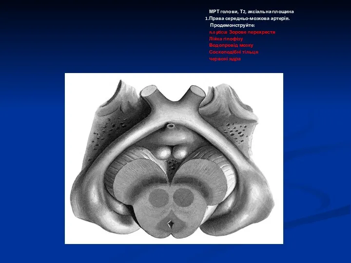 МРТ голови, Т2, аксіальна площина Права середньо-мозкова артерія. Продемонструйте: n.opticus