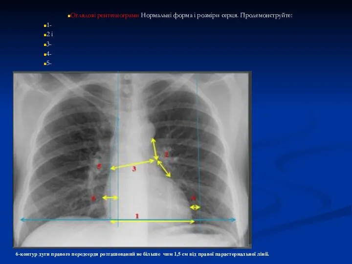 Оглядові рентгенограми Нормальні форма і розміри серця. Продемонструйте: 1- 2