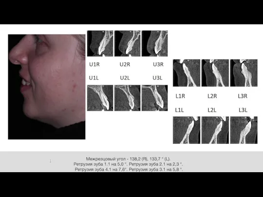 Межрезцовый угол - 138,2 (R), 133,7 ° (L). Ретрузия зуба