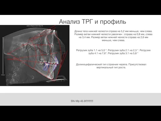 SN-Mp 45.9!!!!!!!!!!! Анализ ТРГ и профиль 32 108 94 Длина