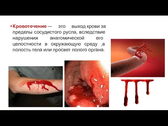 Кровотечение — это выход крови за пределы сосудистого русла, вследствие