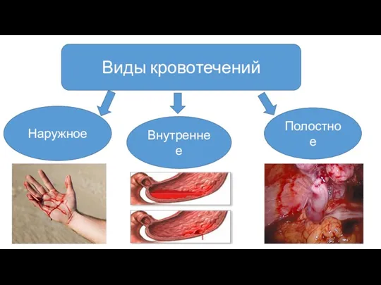 Виды кровотечений Наружное Внутреннее Полостное