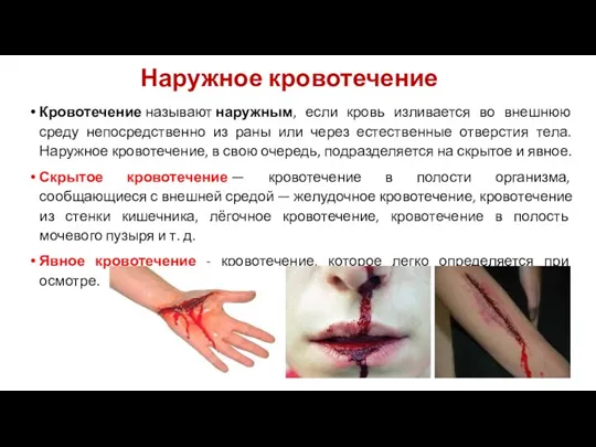 Наружное кровотечение Кровотечение называют наружным, если кровь изливается во внешнюю