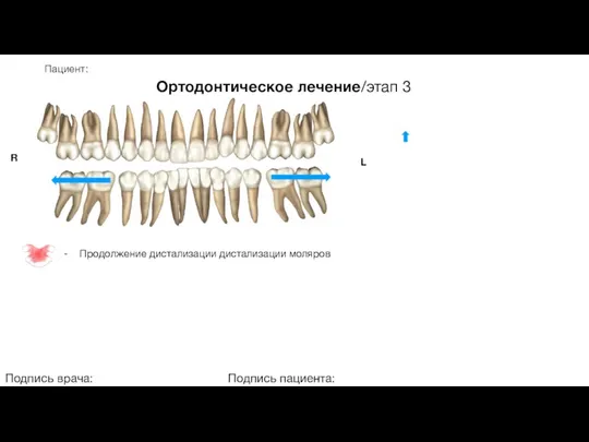 Пациент: Ортодонтическое лечение/этап 3 Подпись врача: Подпись пациента: R L - Продолжение дистализации дистализации моляров